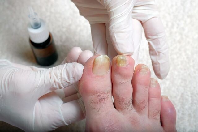 Một số bệnh phổ biến ở móng chân tuyệt đối không thể bỏ qua