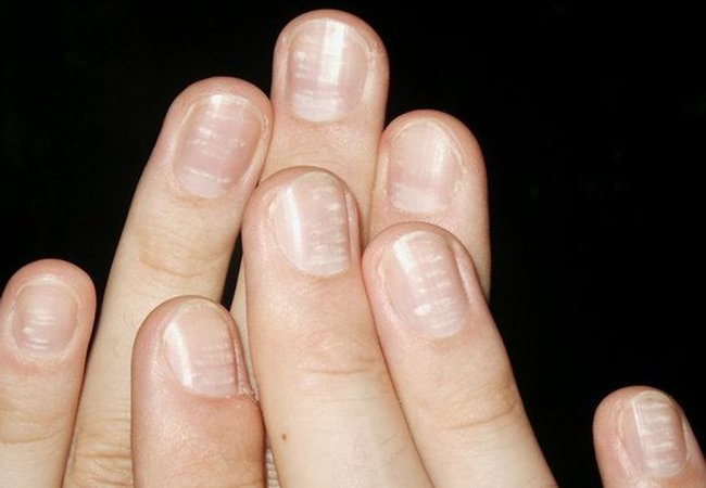 Bệnh vẩy nến móng tay cần có cách điều trị đúng đắn và kịp thời