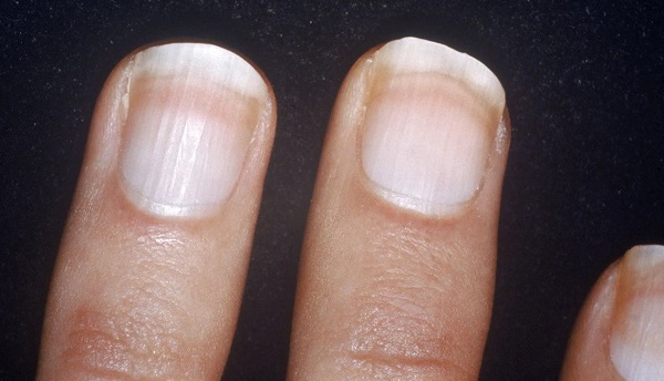 Móng tay có màu trắng là dấu hiệu của các bệnh về gan, thận (Nguồn: Internet)
