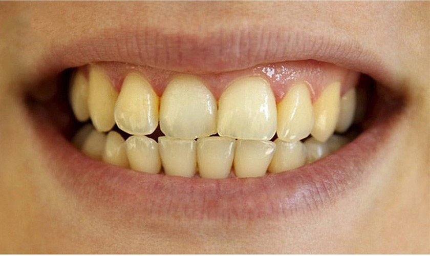 Răng bị ố vàng phải làm thế nào? – 4 cách làm trắng răng hiệu quả tại nhà