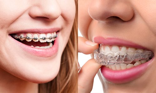 Hướng dẫn chăm sóc răng miệng sau khi niềng răng